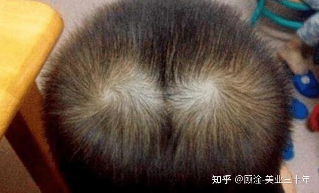 我的这个发旋处的发量是正常的吗？ - 知乎