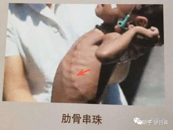 3 到 6 个月的佝偻病宝宝有什么症状呢?