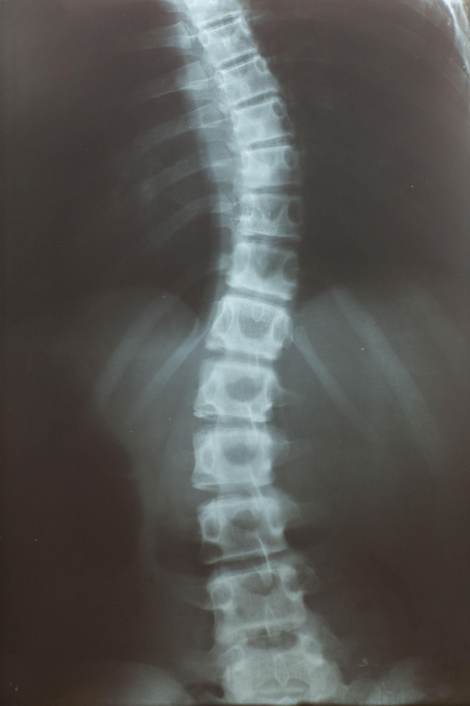 3D打印技术在青少年脊柱畸形治疗中的应用——记青海大学附属医院脊柱外科-青海大学附属医院