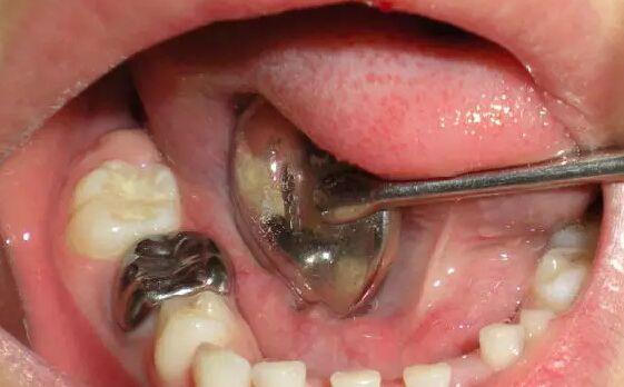 求助,八岁半的小男孩,第一双尖牙烂了,医生说等换牙,可是每天难受怎么