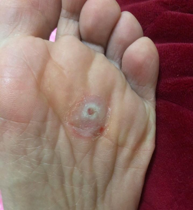 鸡眼怎么治疗? - 知乎