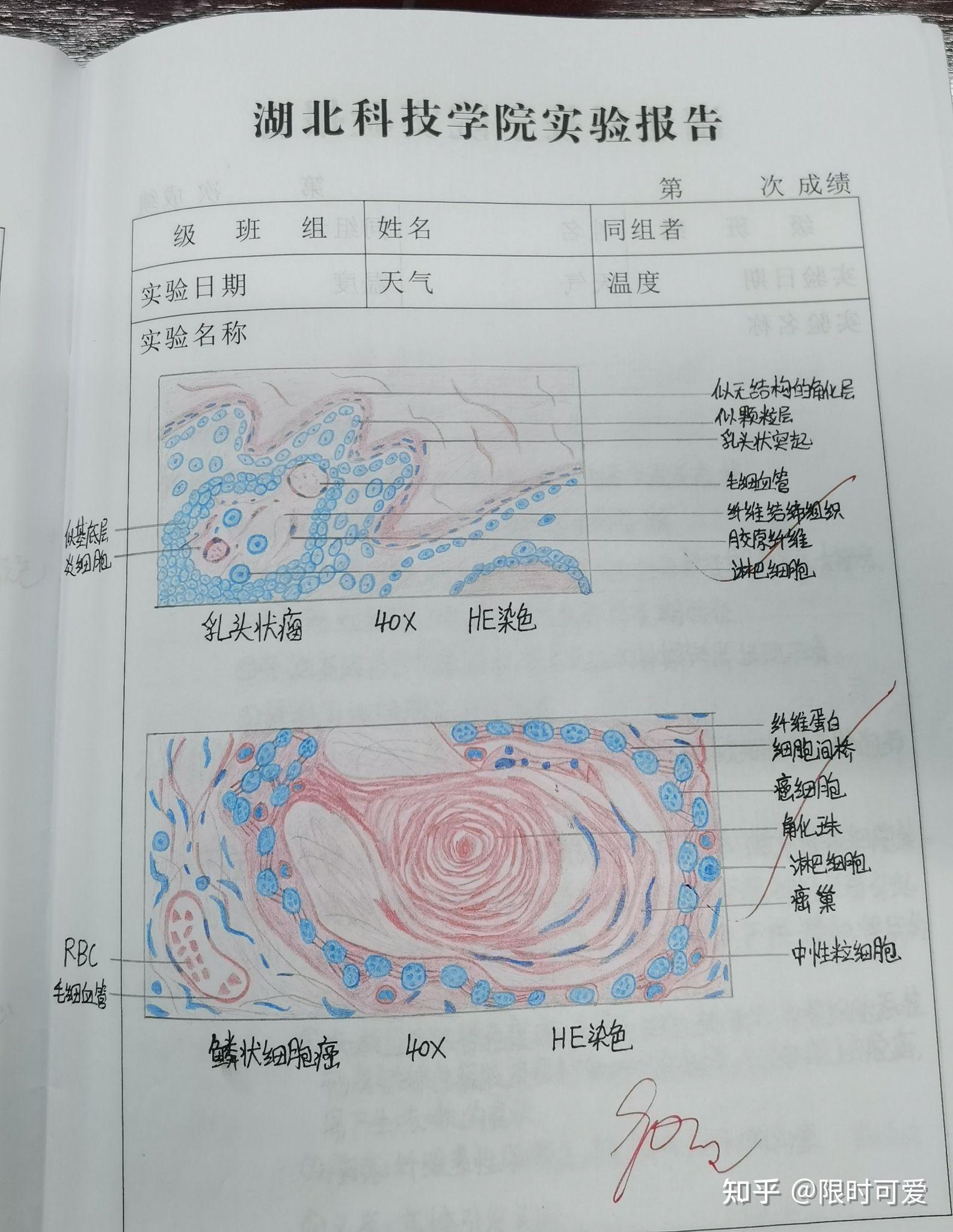 乳腺癌高倍镜下手绘图图片