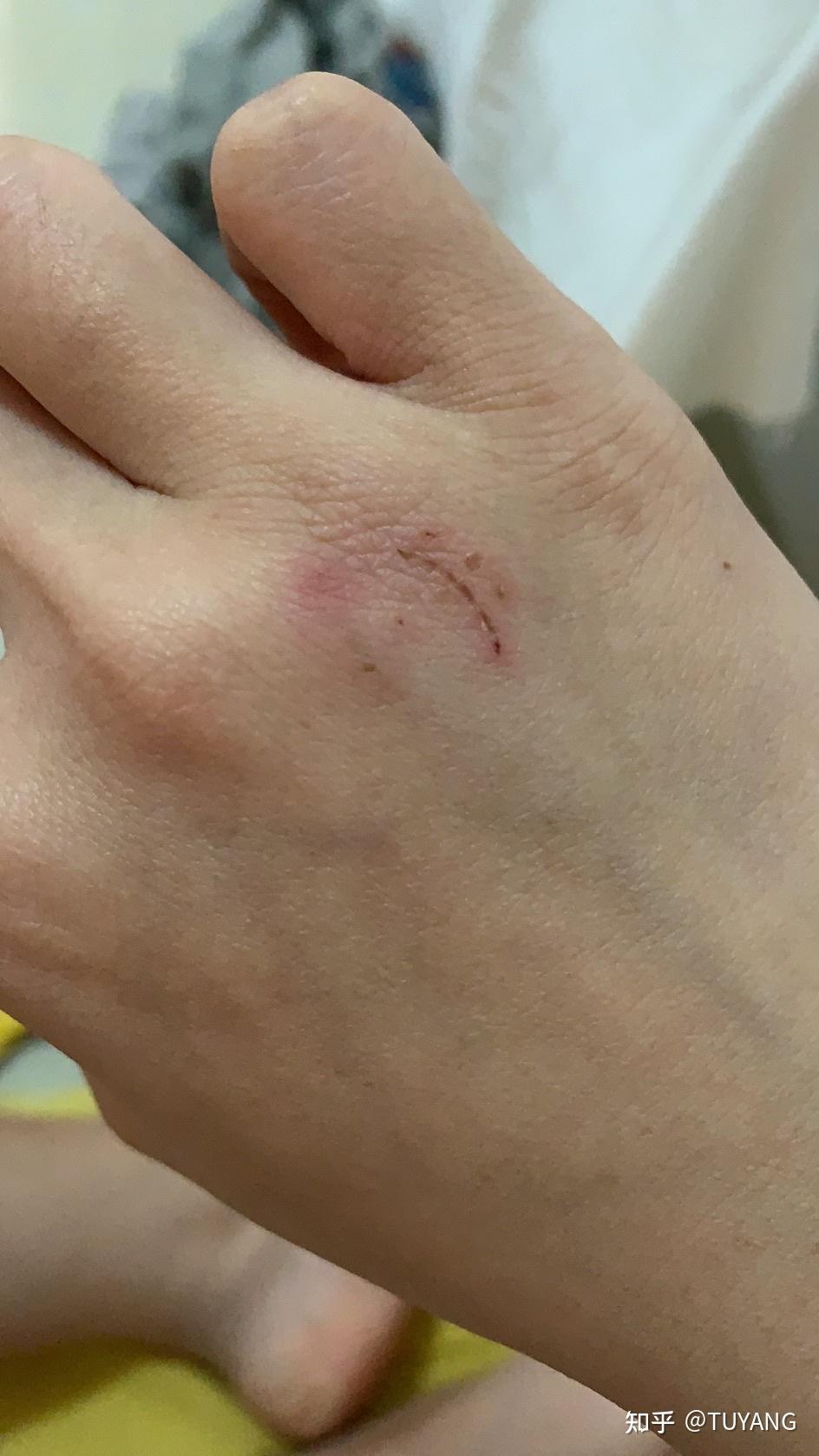 被猫咬伤需要打狂犬疫苗吗