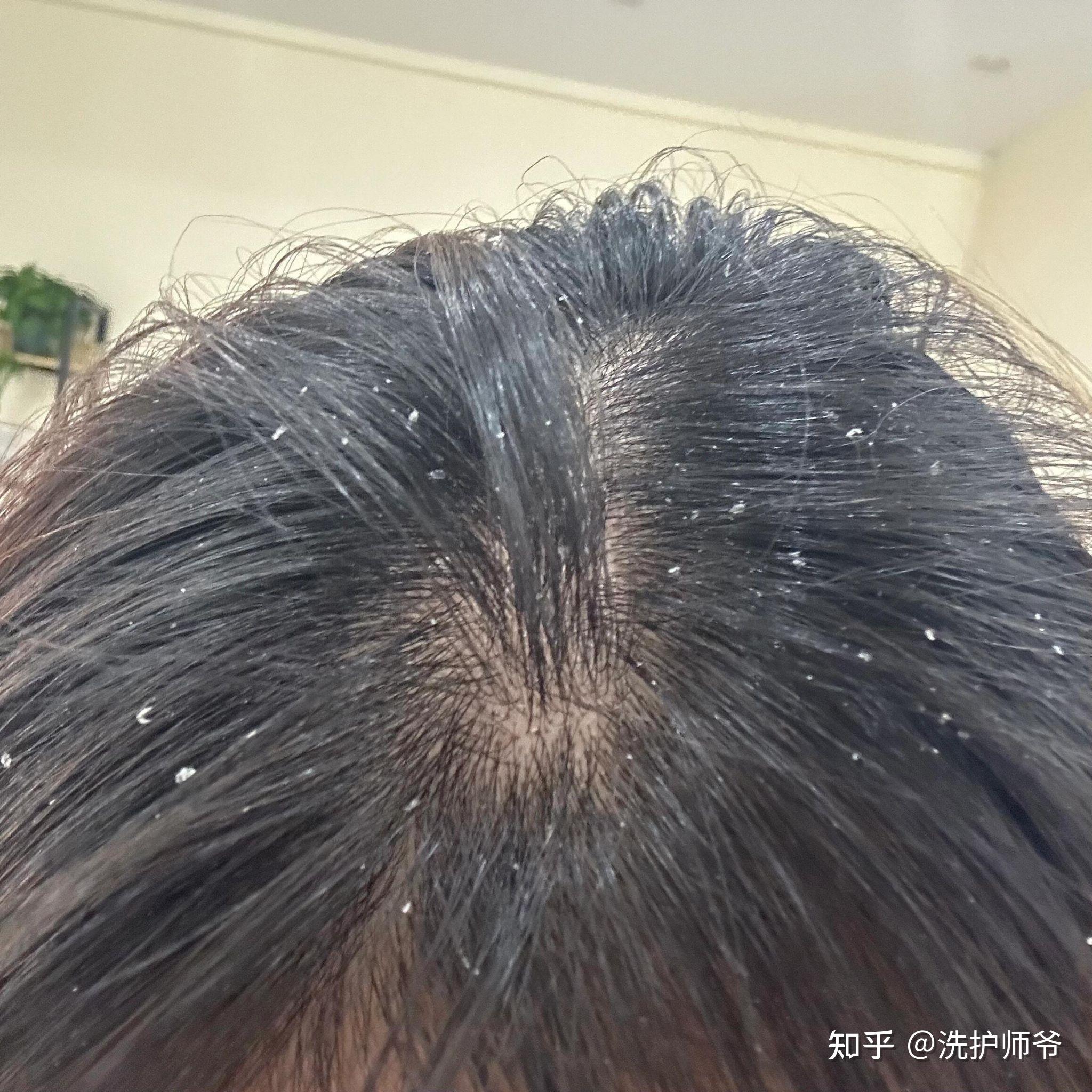 头皮屑怎么产生的主要什么原因 - 知乎