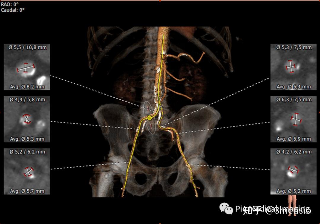 3mensio aortic 