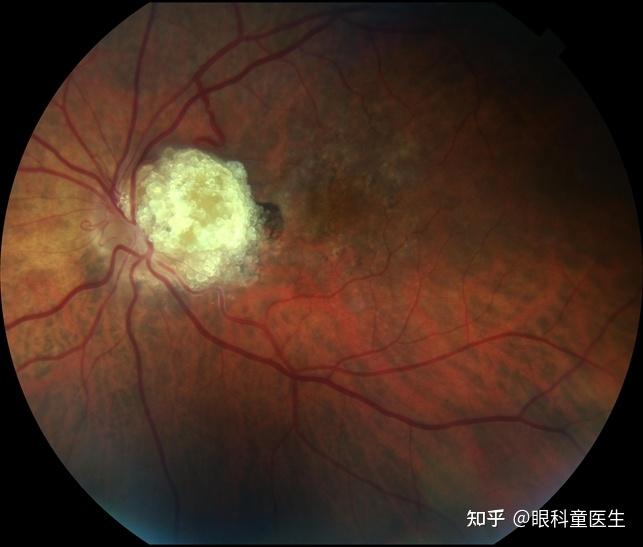 视网膜肿瘤性疾病——4,视网膜星形细胞错构瘤