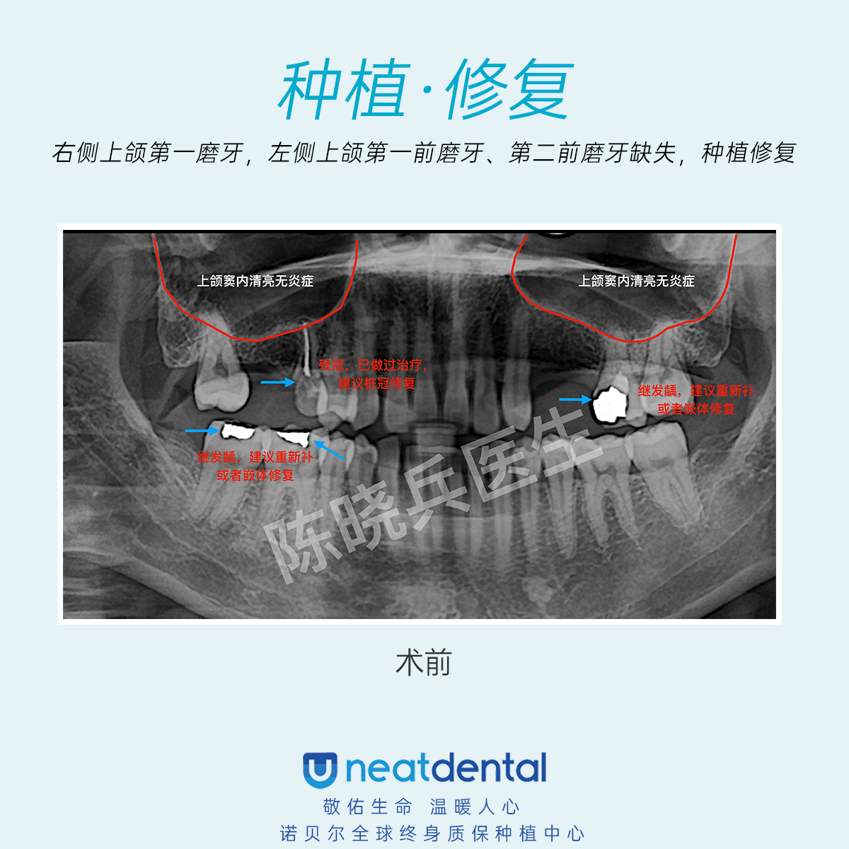 广州种植牙诺贝尔种植体三颗牙缺失种植修复案例分享