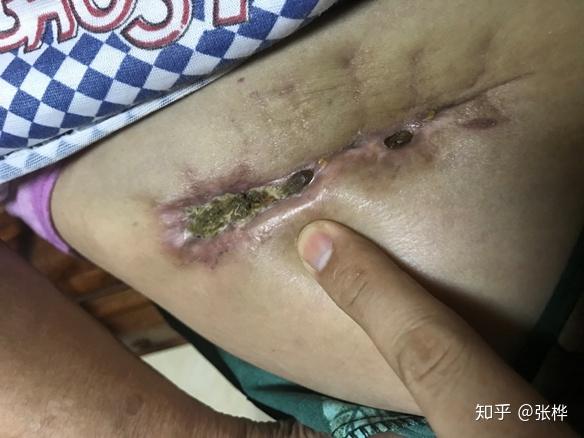医理求真——右髋部血肿清除术后2月伤口不愈合 - 知乎