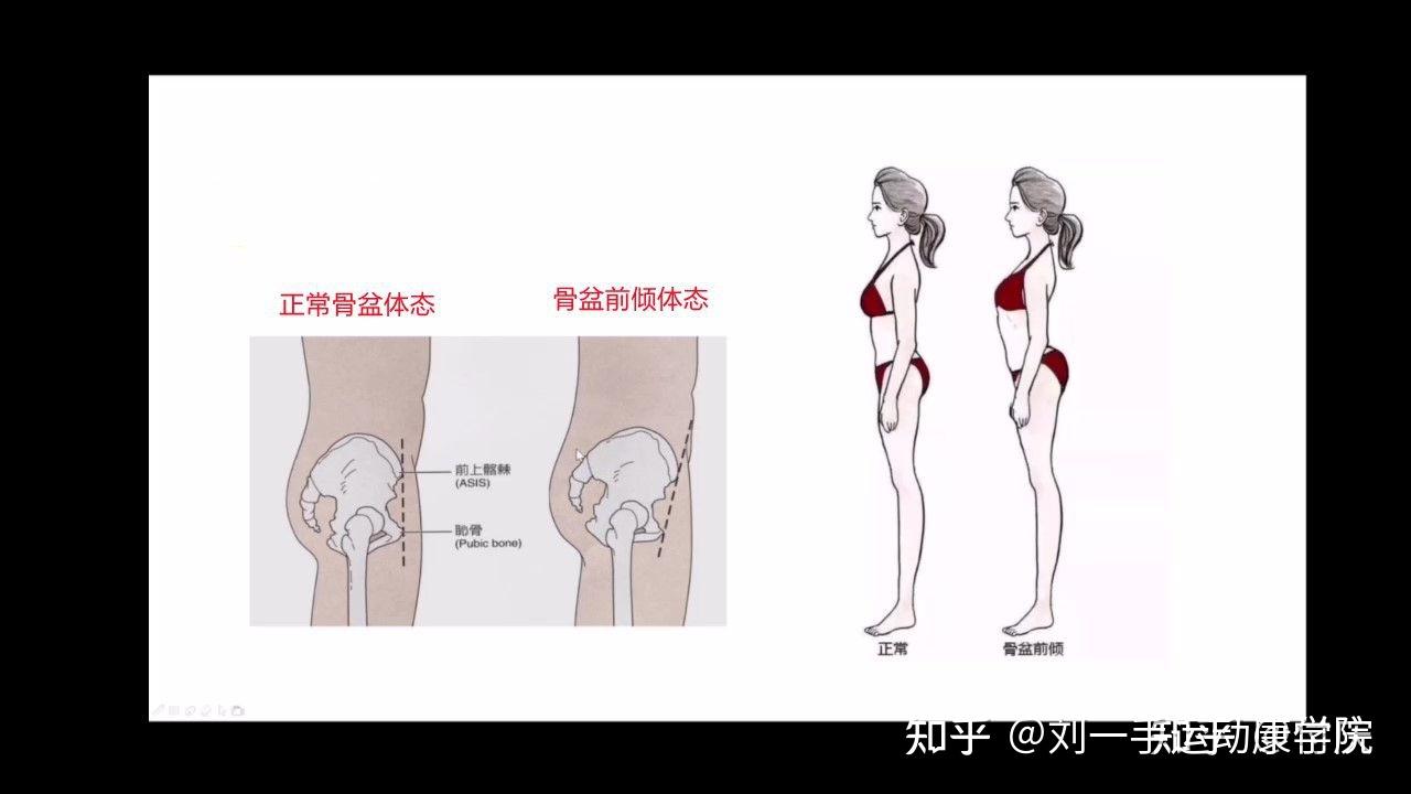 骨盆前倾与后倾自测评估