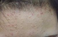 额头上长了闭合性粉刺,怎么治疗呢?