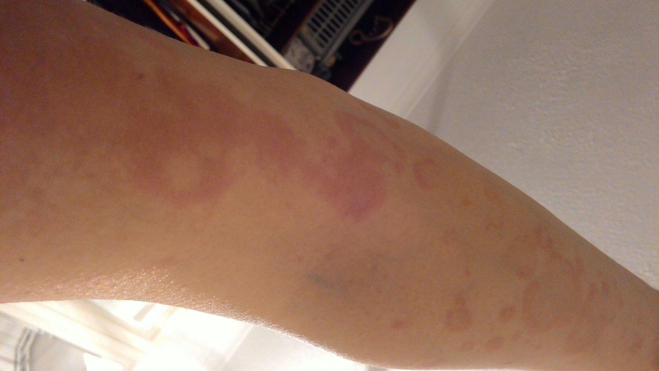 得了荨麻疹是一种怎样的体验? - 知乎