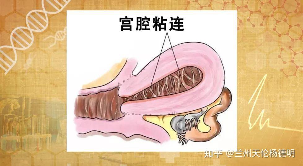 兰州天伦科普时间月经量少小腹疼痛要当心是宫腔粘连