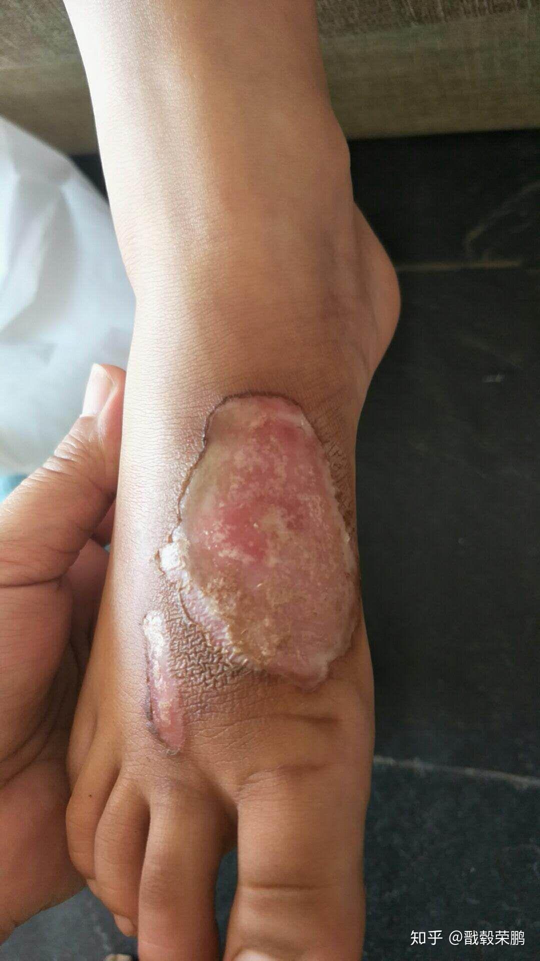 你见过的最好的治烧伤,烫伤的药是什么,有何效果? - 知乎