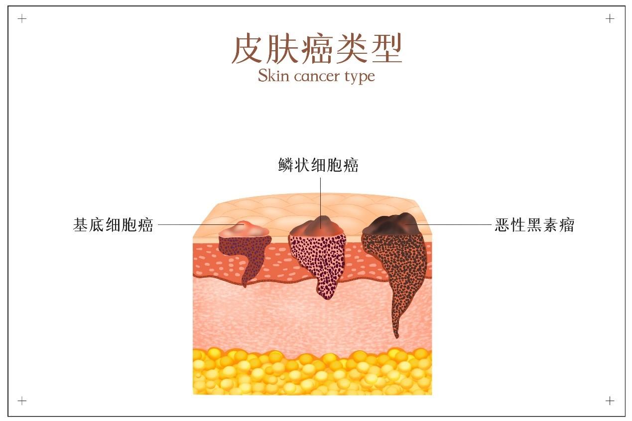 皮肤鳞状细胞癌