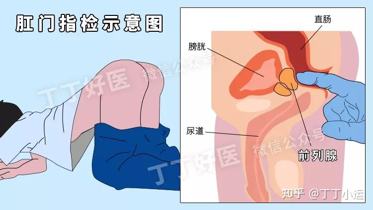 取前列腺液手法图解图片