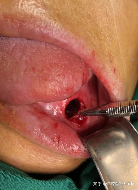 下颌骨囊肿治疗方法和医院