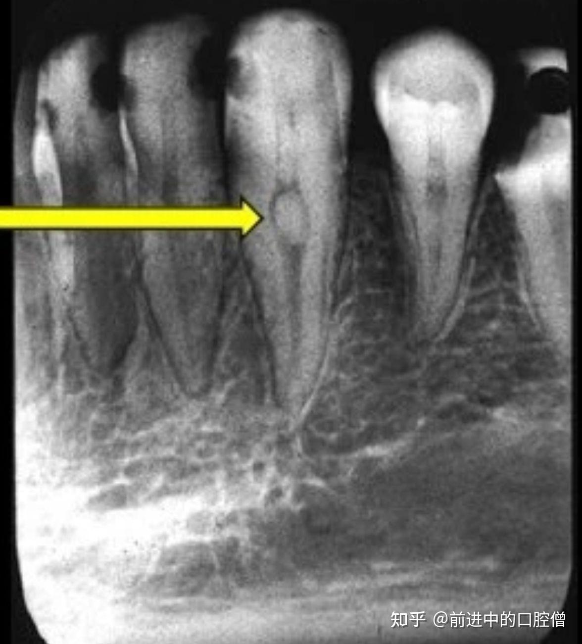 一例牙髓坏死原因的探讨