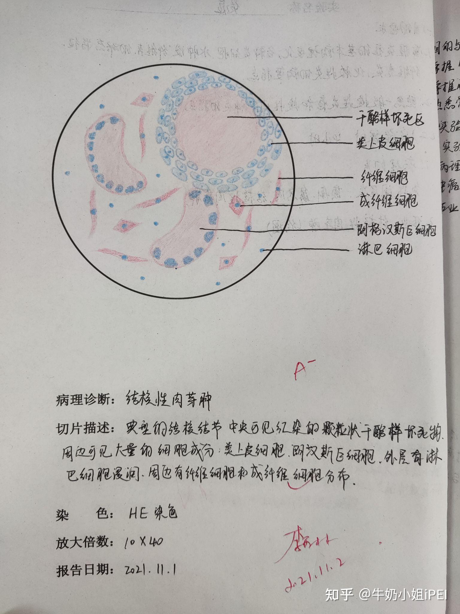 肾浊肿手绘实验报告图图片