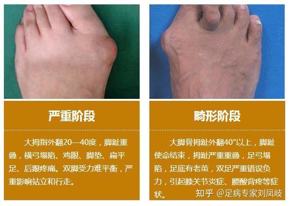 我有扁平足 拇指外翻 有一定程度的外八,鞋子平时外侧磨损非常严重,这