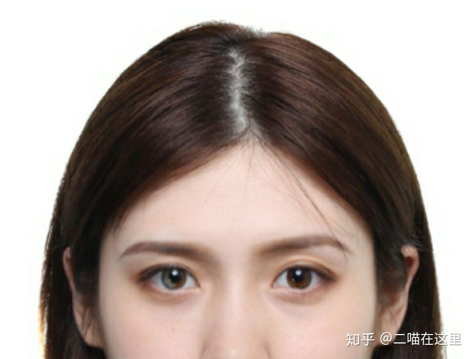 虹膜异色症是种怎样的体验