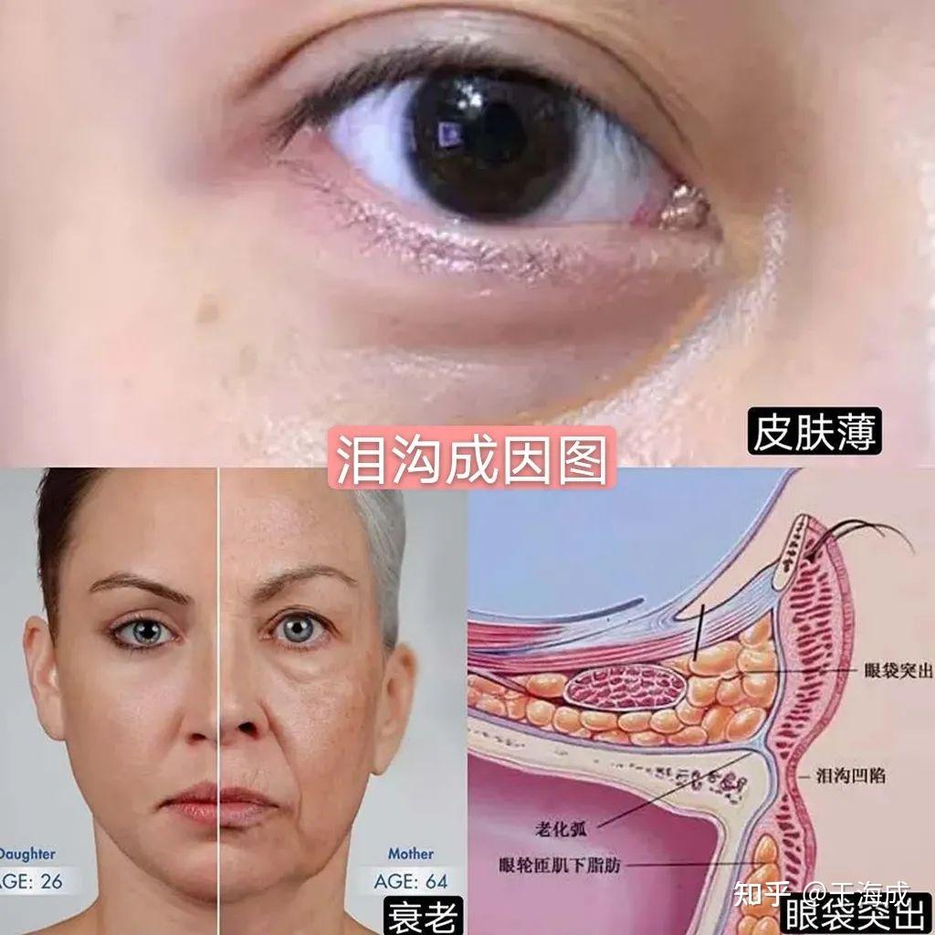 为什么会有泪沟形成为什么在线