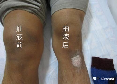 髋关节滑膜炎该如何恢复?
