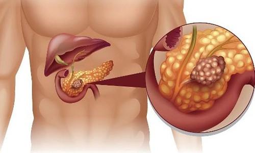 守护胰脏健康调整饮食减轻胰脏负担