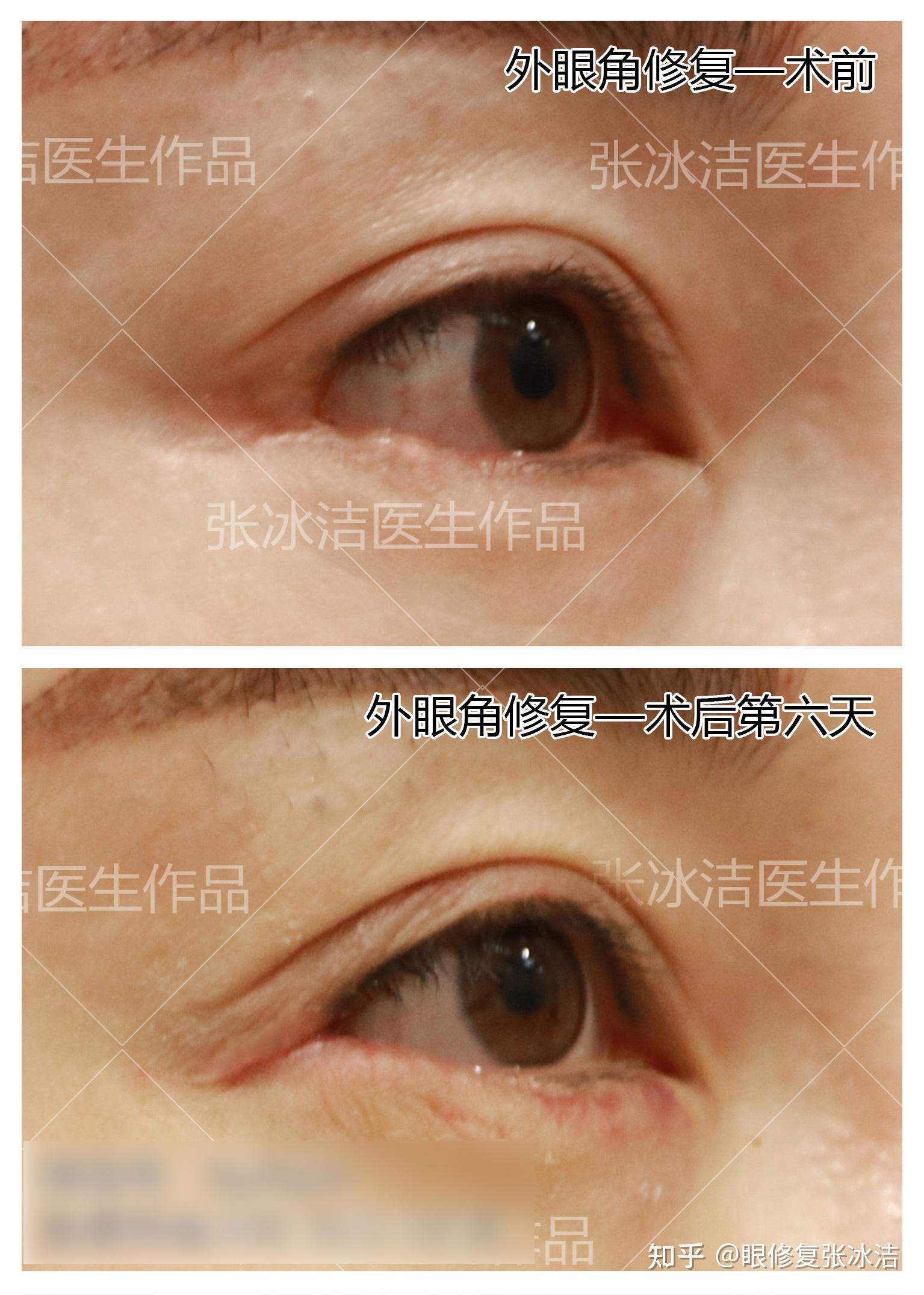 张冰洁外修复眼角案例丨外眼角疤痕,粘连修复案例总汇 - 知乎