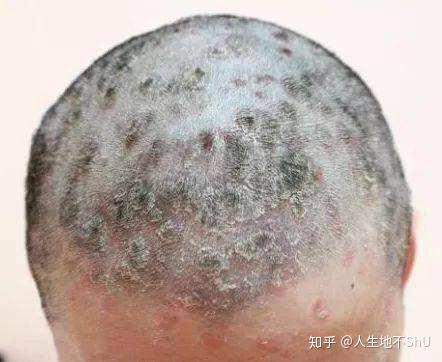 头皮很痒应该怎么办? - 知乎