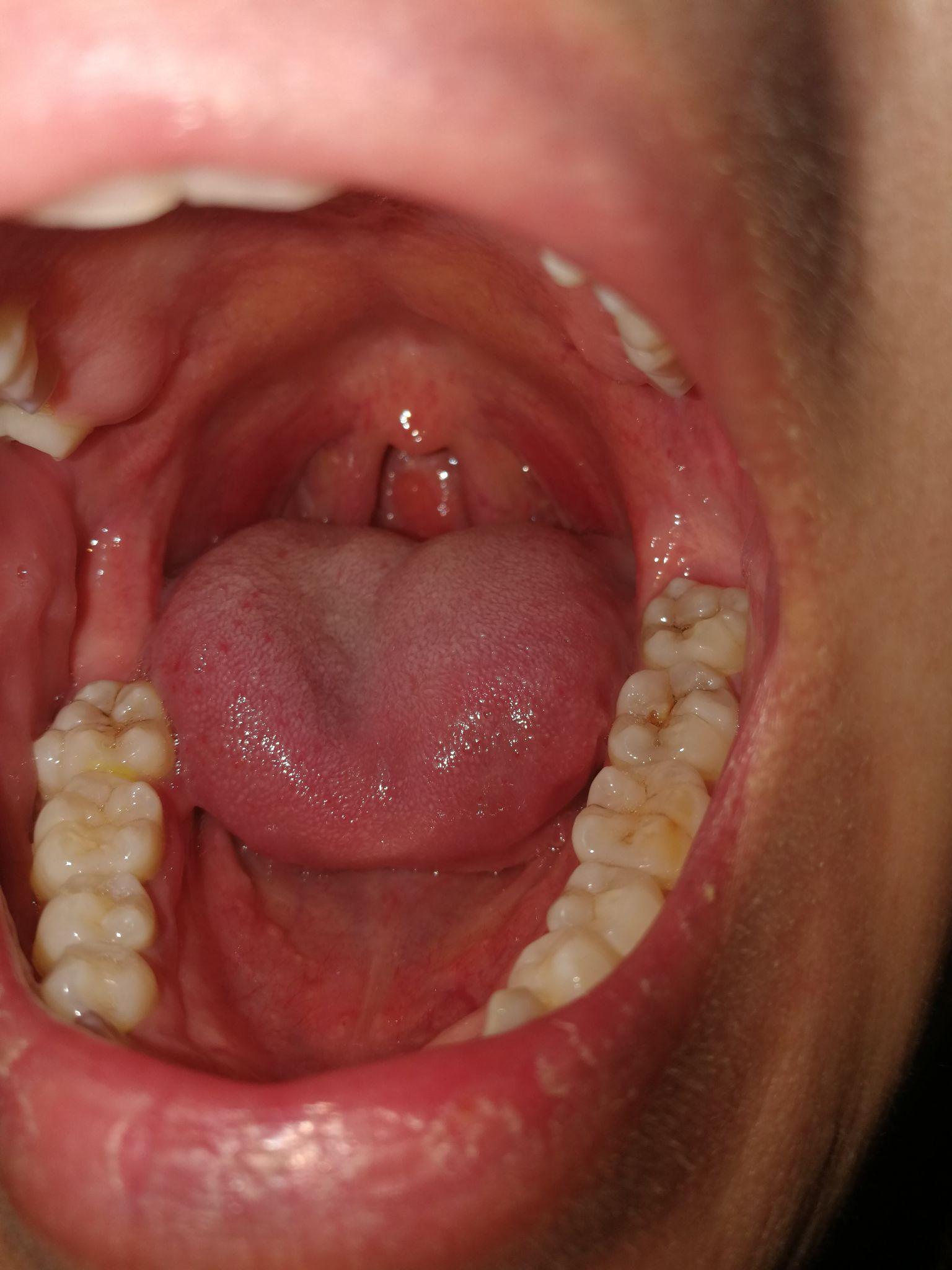 扁桃体结石是如何形成的? - 知乎