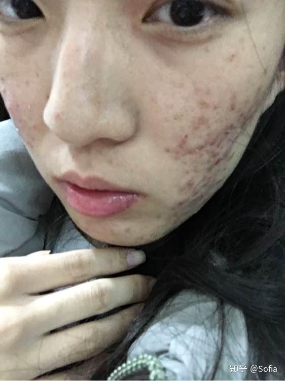 求助挤出来的痘痘全是血还有些许黄白脓状物不是用力挤轻轻一挤就是血