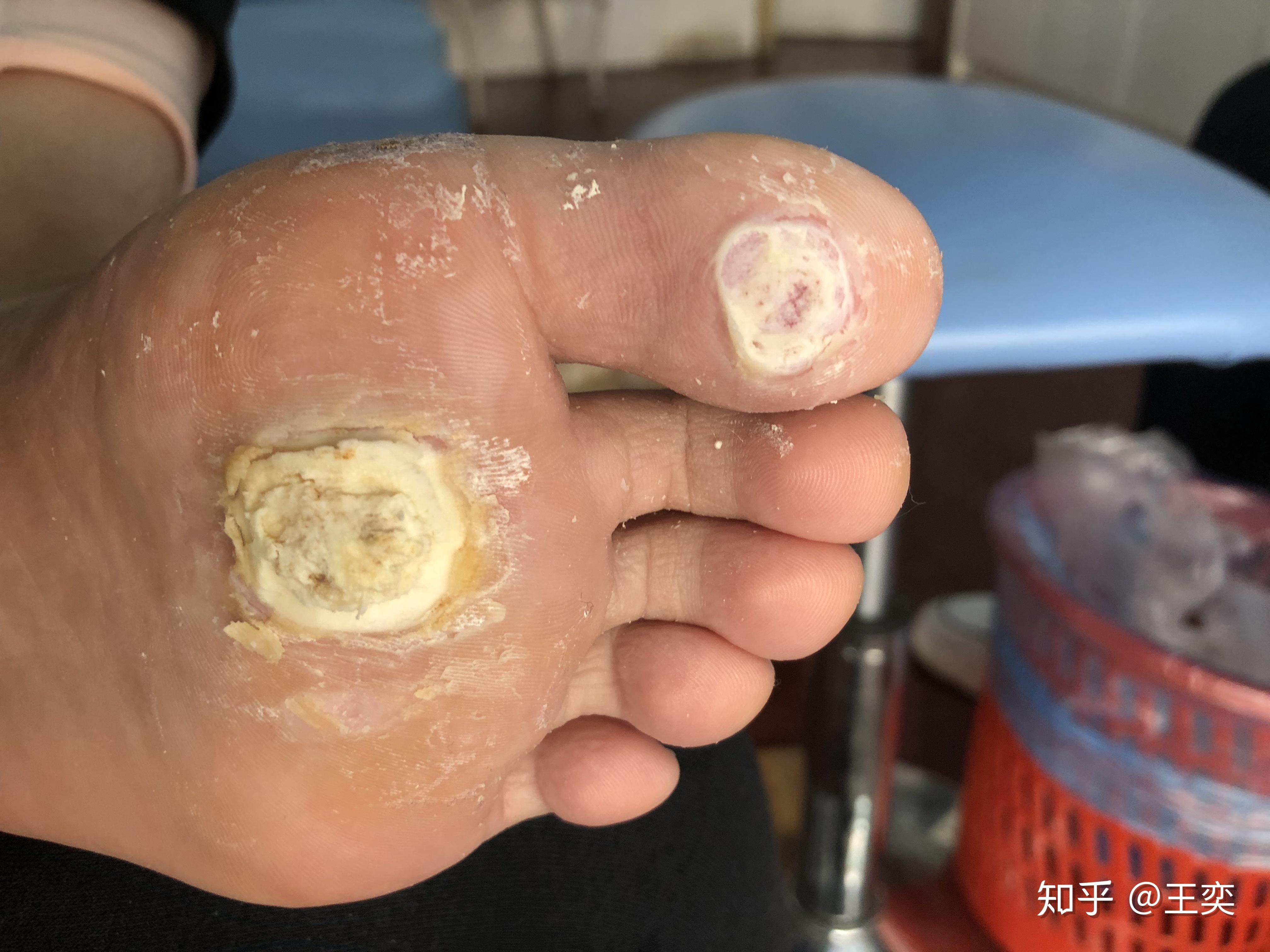 跖疣治疗之路-已成功709915