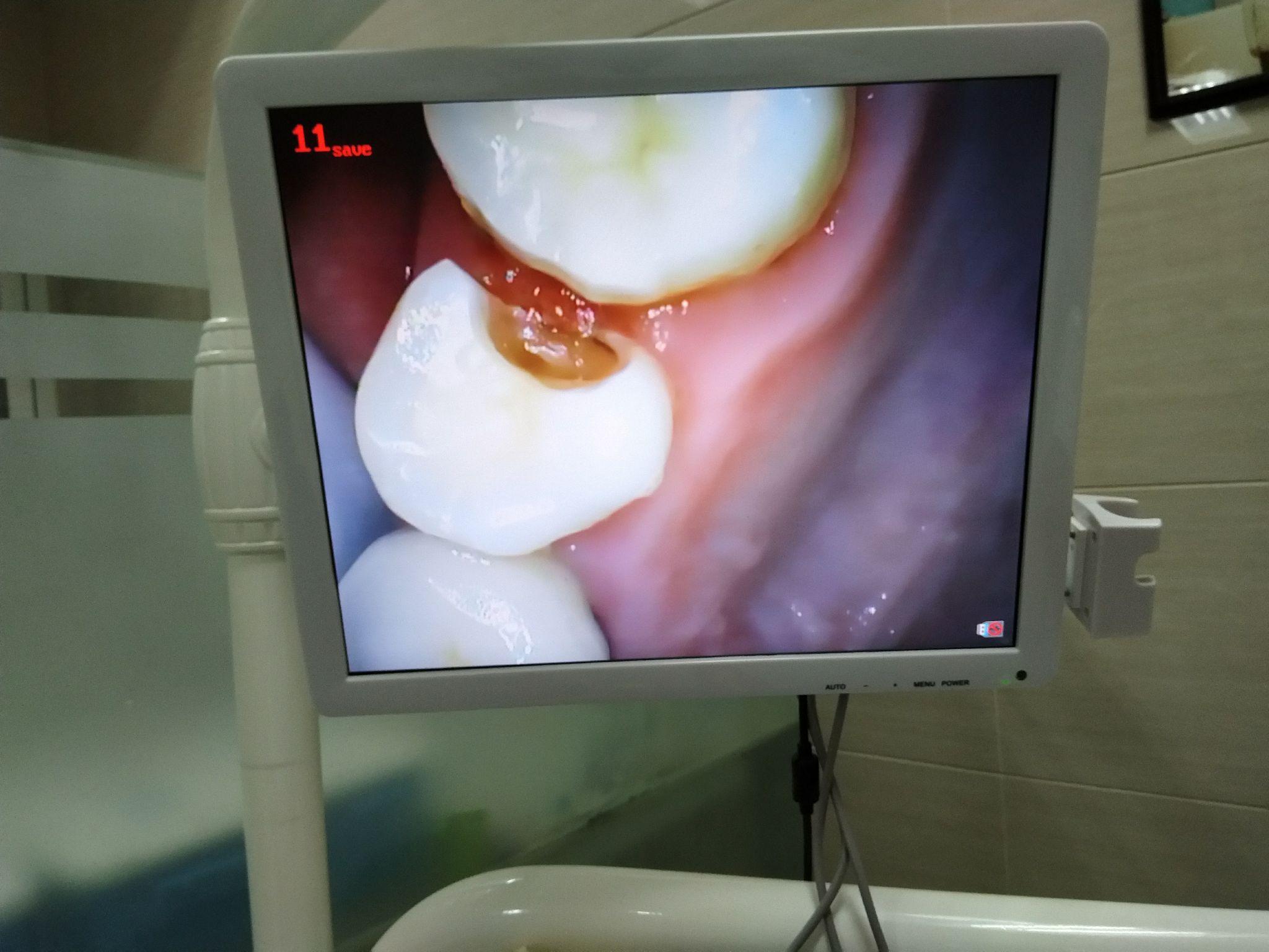 不容易发现的邻面龋2