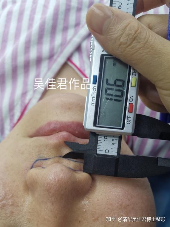 99的人不懂人中长的辛酸