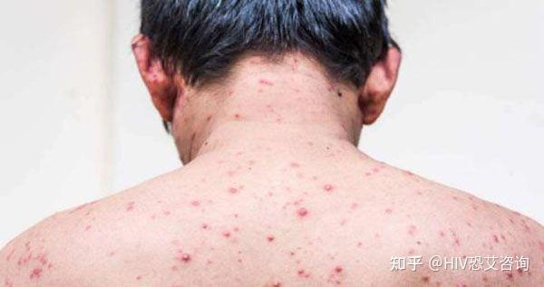 艾滋病初期症状皮疹多久会消失？ - 知乎