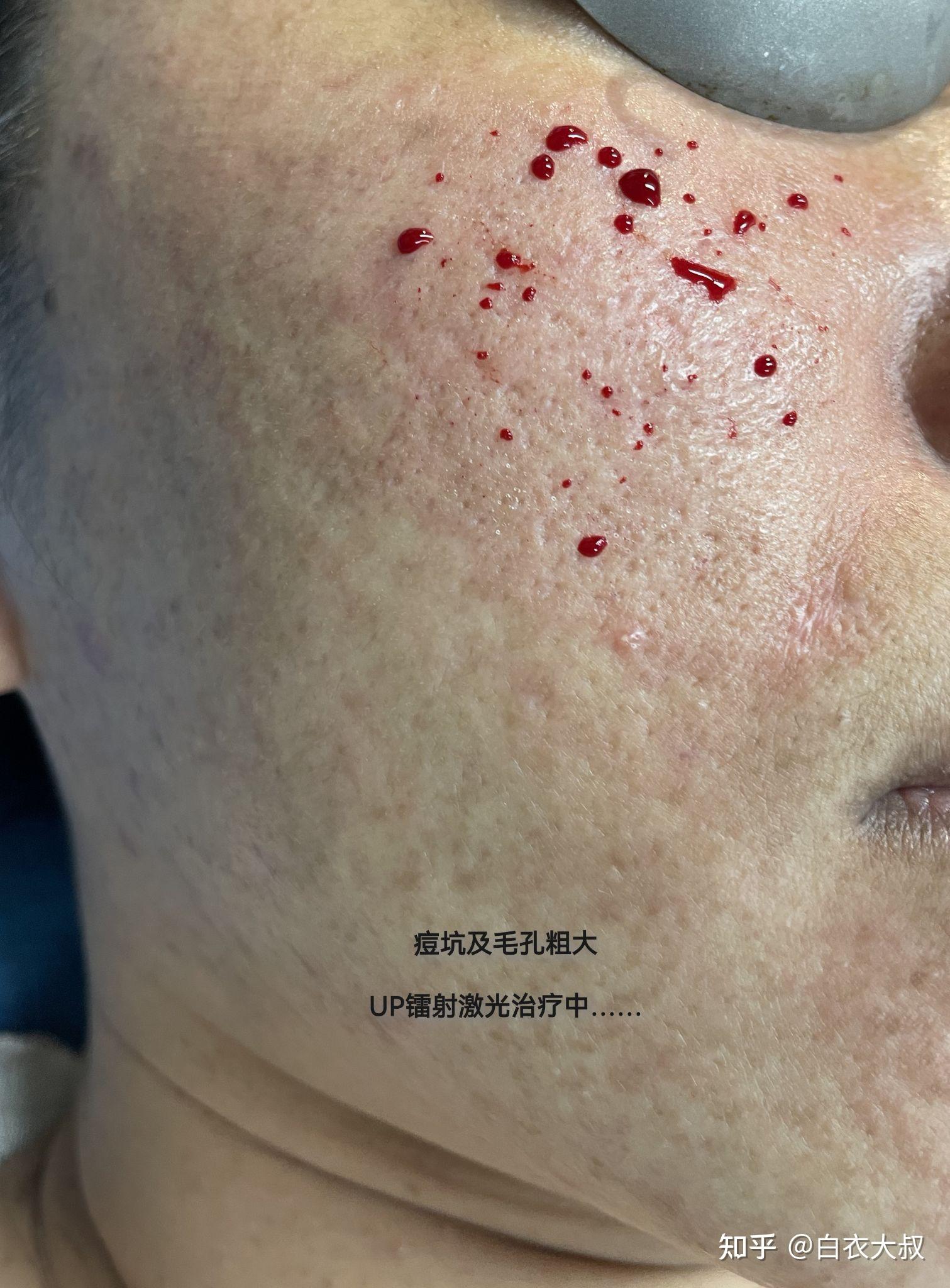 临床治疗分享up镭射激光治疗痘坑