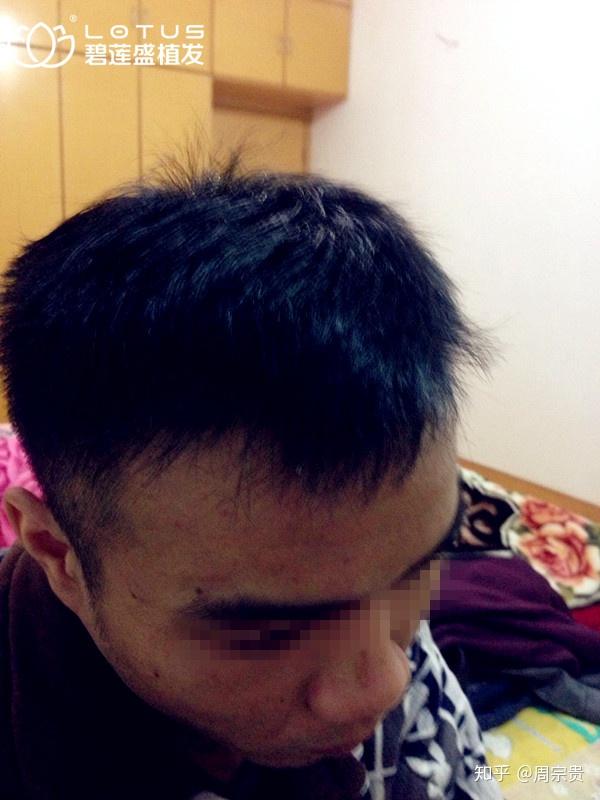从额角开始的脱发,为什么那么难发现? - 知乎