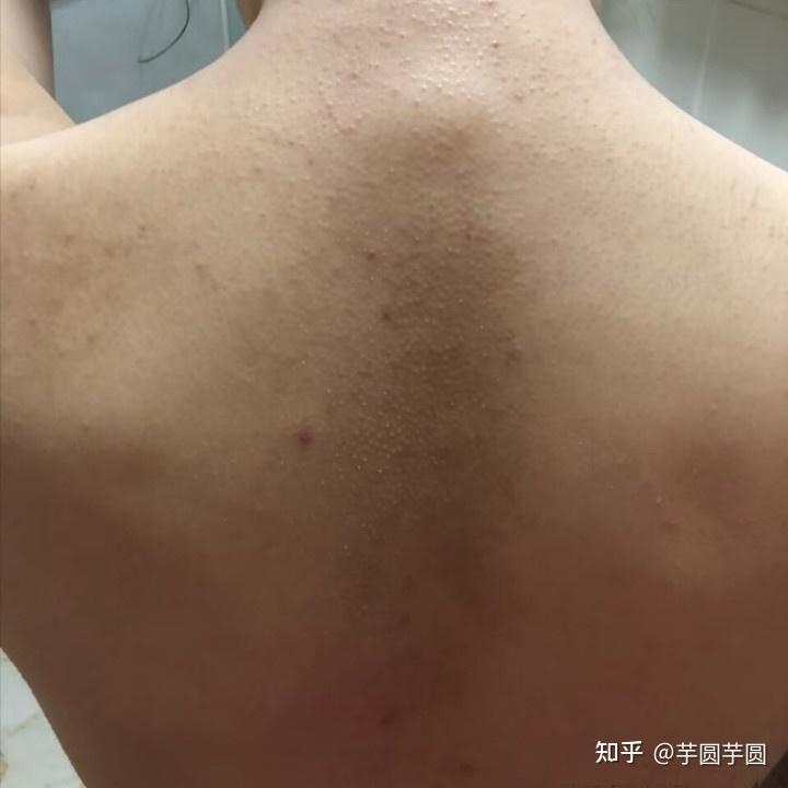 背痘反复，是因为洗澡没洗干净吗？ - 知乎