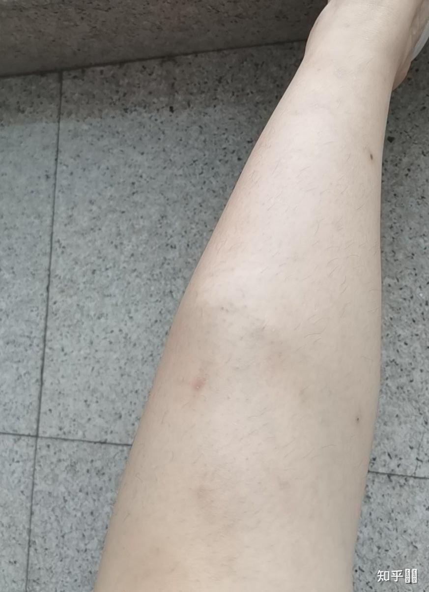 我的小腿有血管瘤,是长在肌肉里面的,表面看不出来,但是明显左右腿不