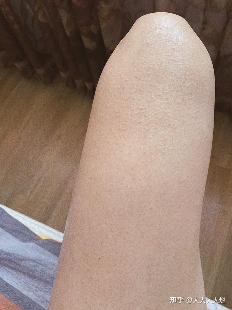 先天性鸡皮肤脸红(脸上遗传性鸡皮肤脸红很严重) 先天性鸡皮肤脸红(脸上遗传性鸡皮肤脸红很严重)