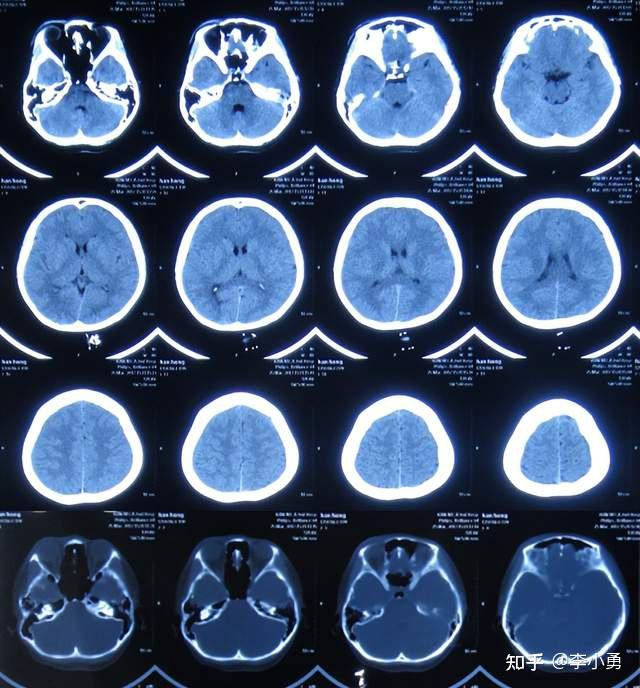 近致命性結核腦膜炎性腦積水發病後2個月內先後經4家醫院治後仍無改善