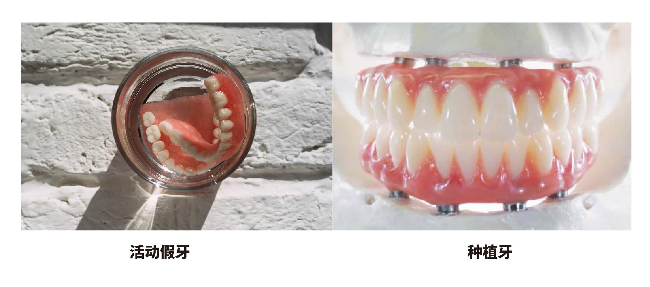 老年人的活动假牙应该如何维护？_口腔修复_口腔修复护理及注意事项 - 好大夫在线