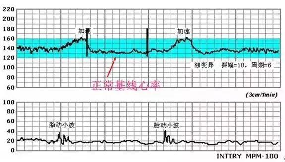 胎心监测 知乎