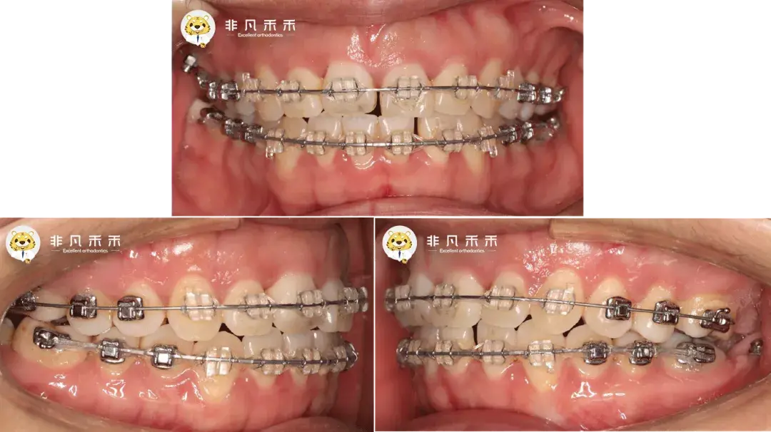 018不鏽鋼絲,小圈曲,雙側主動結紮加力,滑動關閉散在間隙,2-2橡皮鏈連