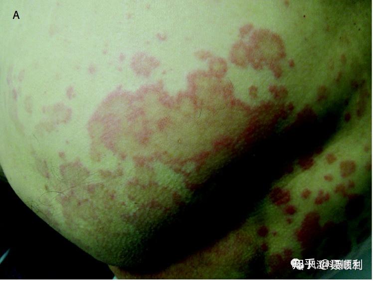 一,蕁麻疹性血管炎 (urticarial vasculitis, uv)