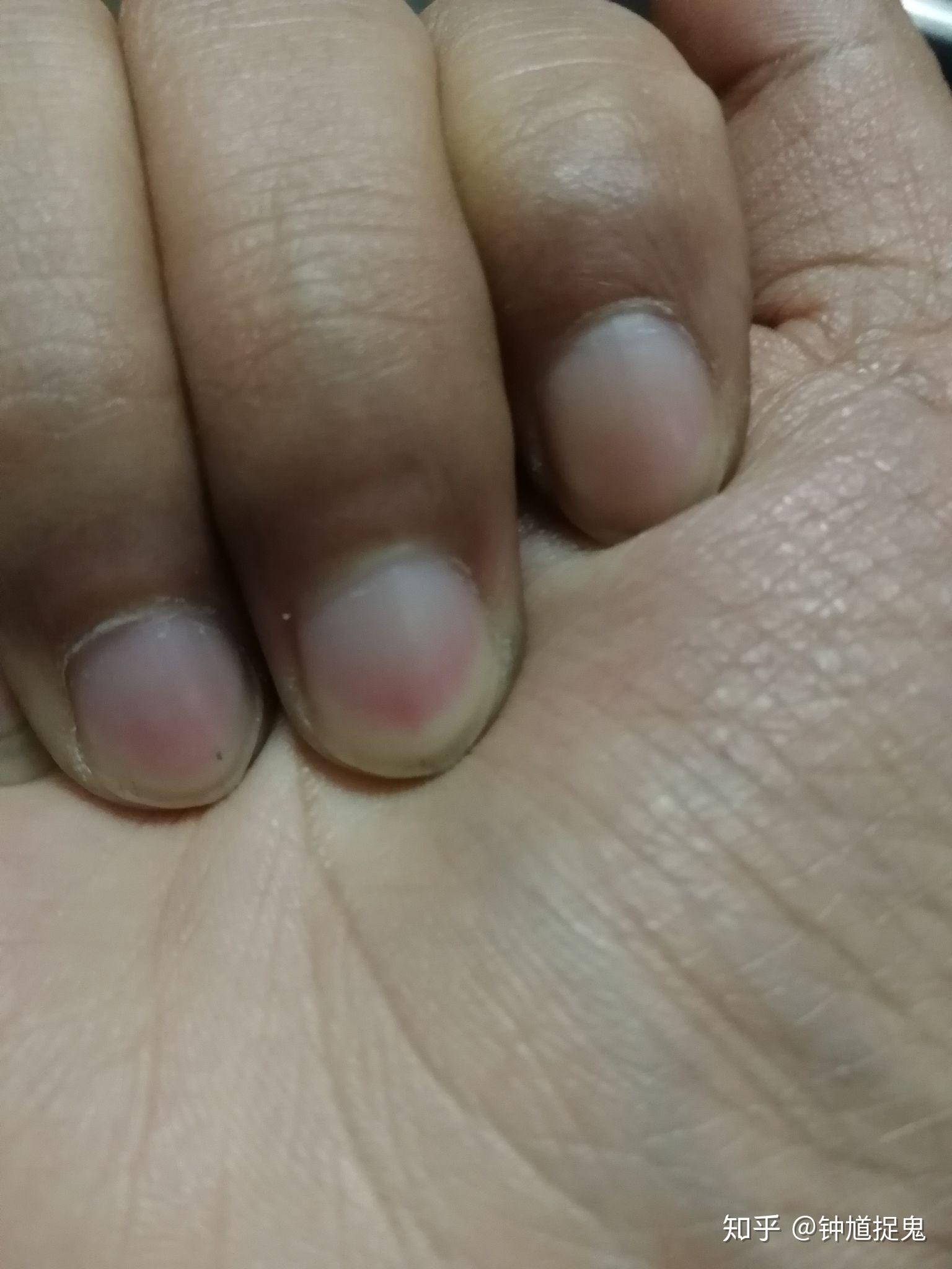 指甲下面的黑点