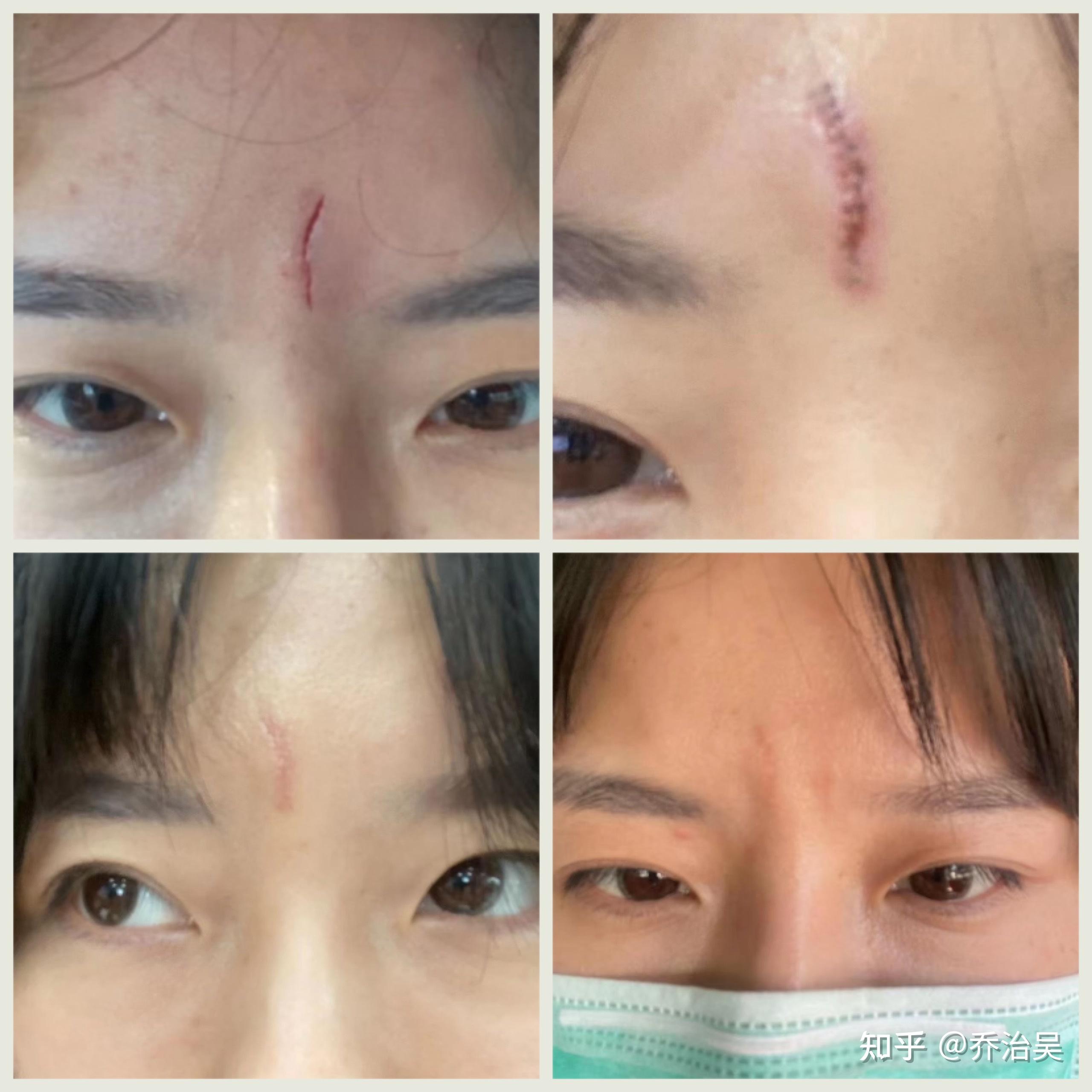 芭克4支效果对比如果你是疤痕增生(疙瘩)了,那么涂抹再多芭克都是没有