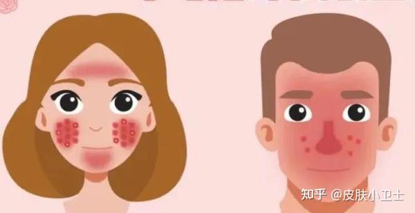 脸部皮肤干燥、发红或敏感是咋回事? - 知乎