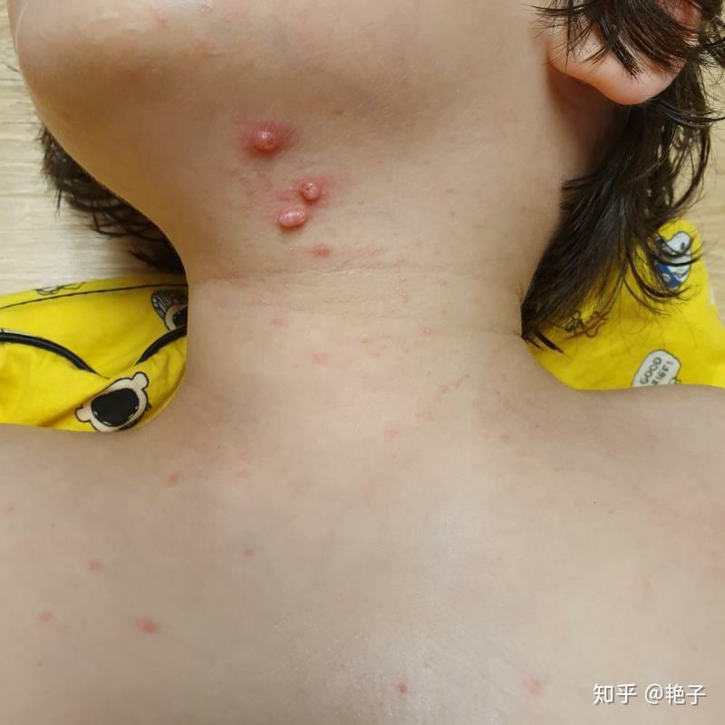 有传染性软疣要注意什么?有什么忌口的?