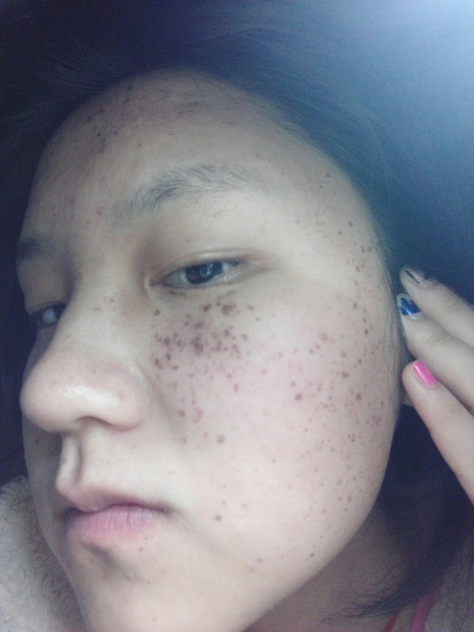 求高人指点治疗遗传性雀斑的最佳方法激光光子